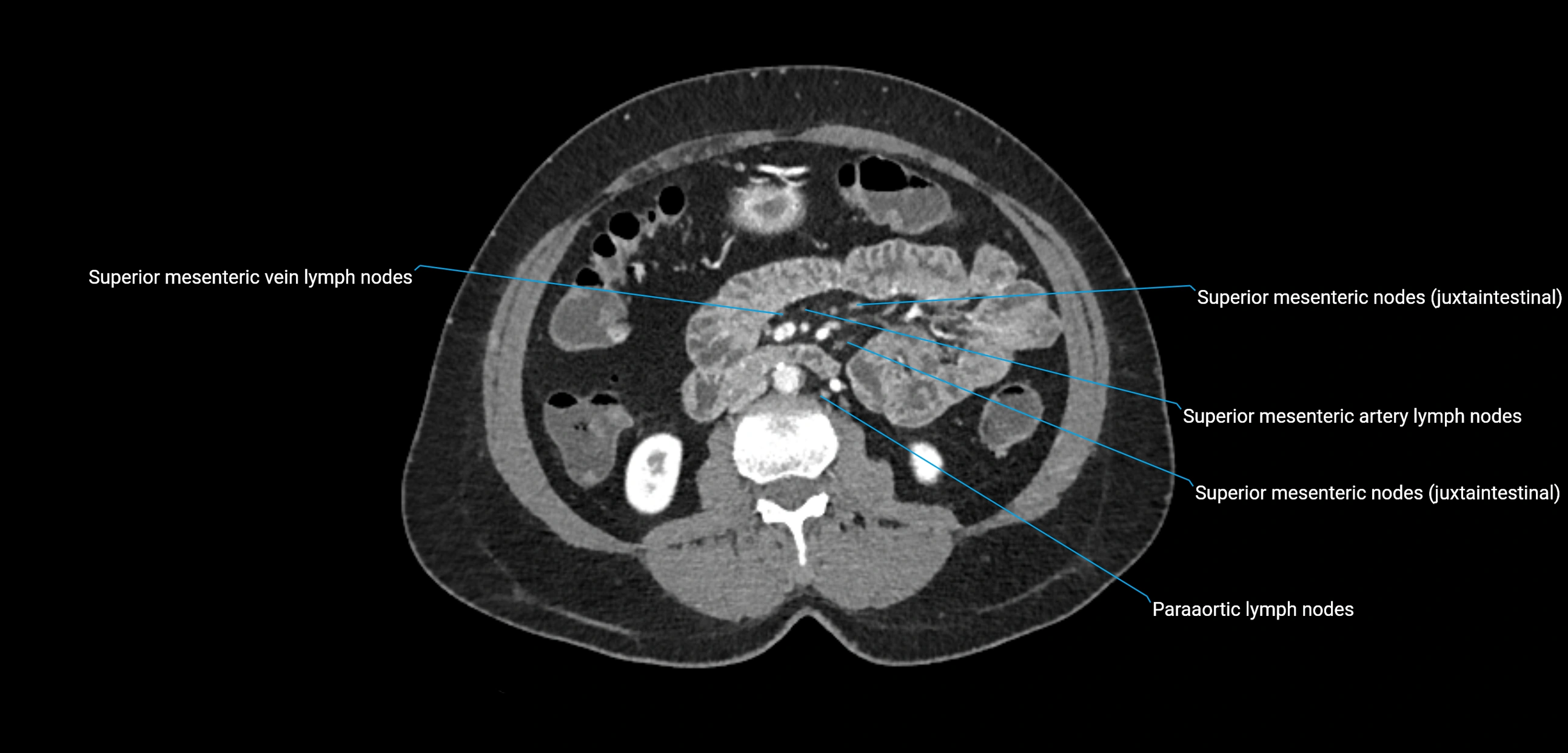 CT ct abdominal lymph nodes  axial cross sectional anatomy  enchanced radiology image -img-00002-00213.webp